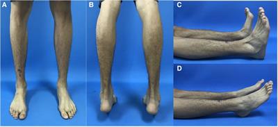 Robot-assisted percutaneous screw fixation in the treatment of navicular fracture